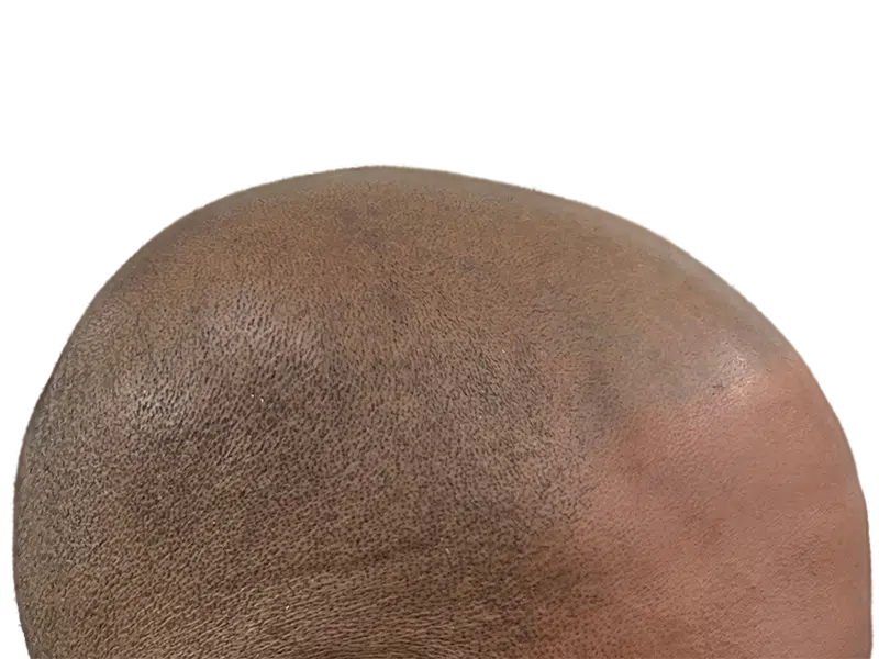 Close-up of scalp showing hair follicles. Could be before/after hair restoration or transplant. Skin tone variation visible.