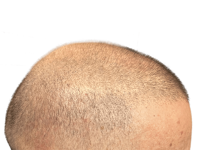 Hair restoration result: Even hair distribution on scalp. Possible hair transplant success. Before/after comparison recommended.