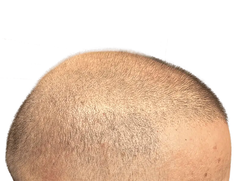 Hair restoration result: Even hair distribution on scalp. Possible hair transplant success. Before/after comparison recommended.