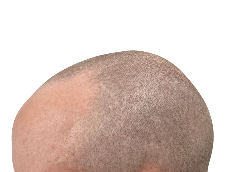 Hair transplant result: Evenly distributed, light hair on fair skin. Successful hair restoration, no baldness visible.