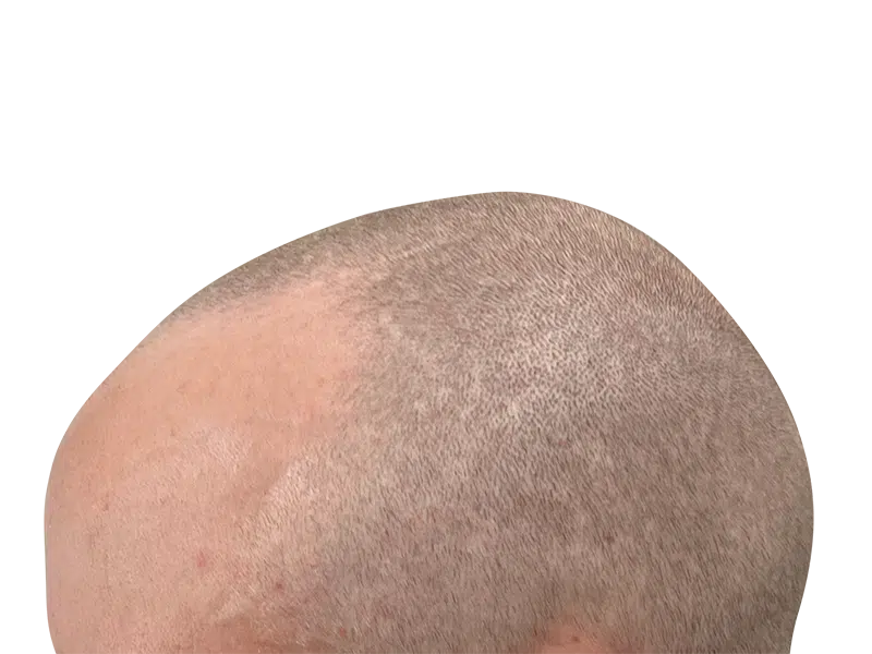 Hair transplant result: Evenly distributed, light hair on fair skin. Successful hair restoration, no baldness visible.