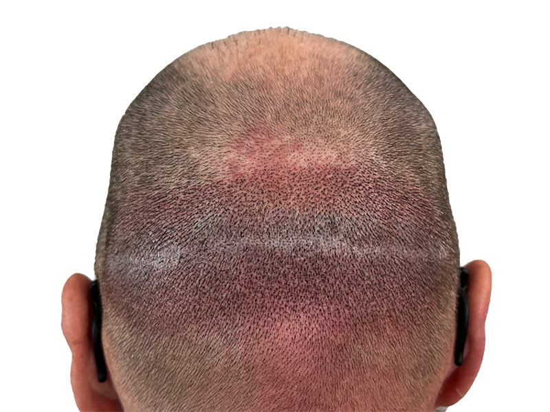 Hair transplant scar on shaved head. Result of FUT/strip harvesting. Hair restoration procedure aftermath.