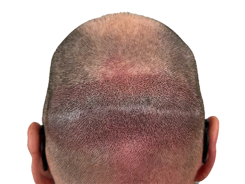 Hair transplant scar on shaved head. Result of FUT/strip harvesting. Hair restoration procedure aftermath.