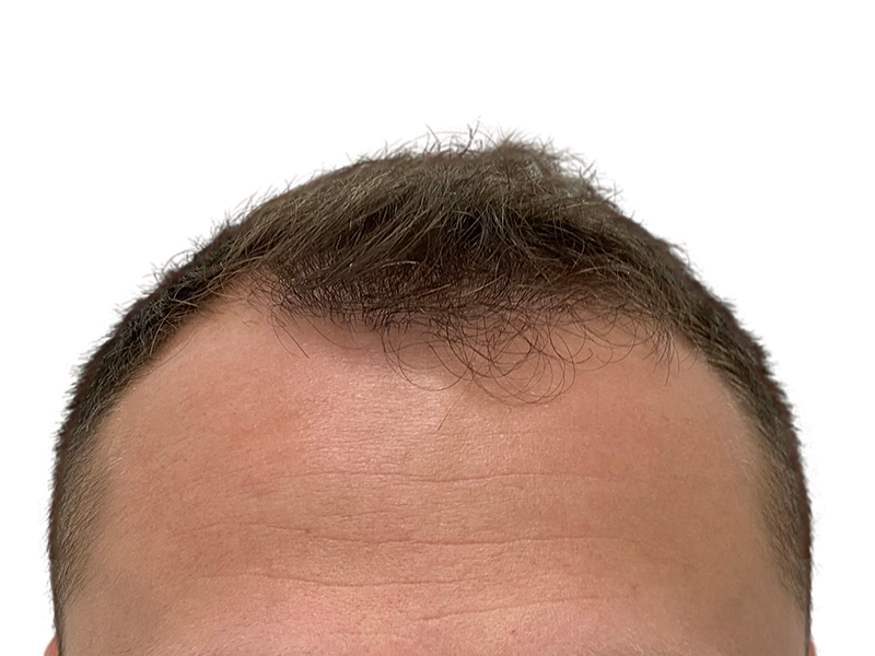 Receding hairline. Potential hair loss candidate. Consider hair restoration or transplant options for fuller hair.
