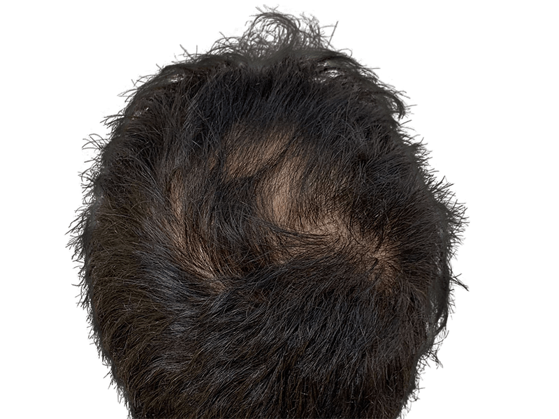 Thinning dark hair on crown. Potential hair loss. Consider hair restoration or transplant options. Before/after possibilities.