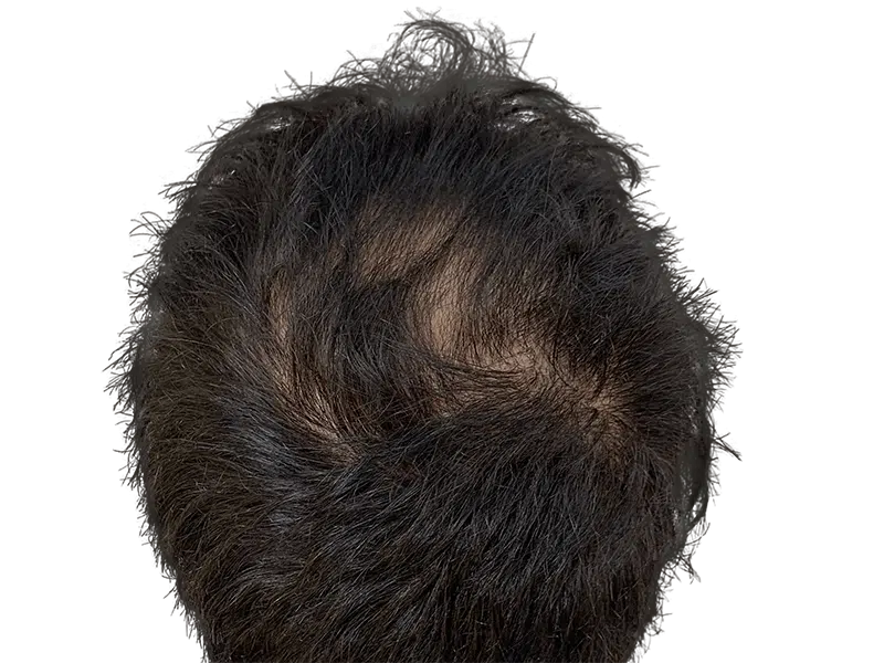 Thinning dark hair on crown. Potential hair loss. Consider hair restoration or transplant options. Before/after possibilities.