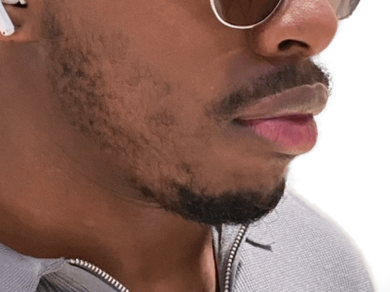 African American man with beard. Potential hair transplant patient. Before/after comparison possible. Hair restoration services.