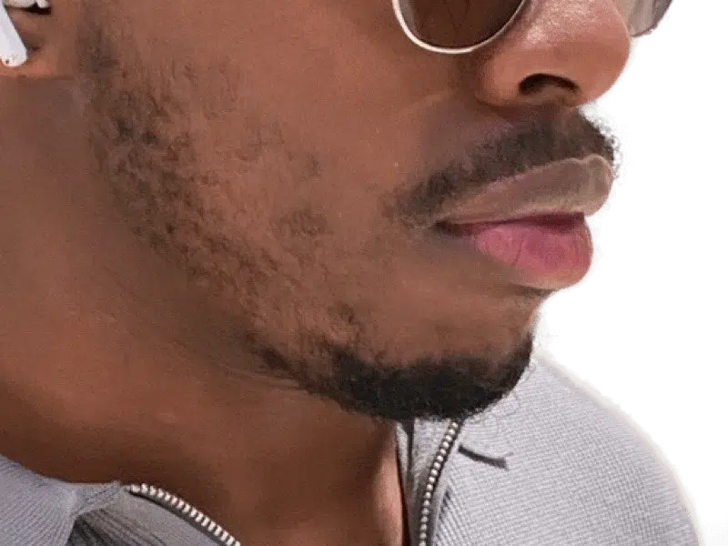 African American man with beard. Potential hair transplant patient. Before/after comparison possible. Hair restoration services.