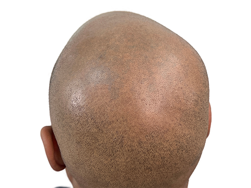 Scalp close-up: Hair transplant result. Even hair follicle distribution. Hair restoration procedure. Before/After potential.
