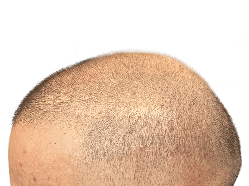 Hair restoration result: Dense, light brown hair after transplant. Improved coverage on scalp. Before/after possible.