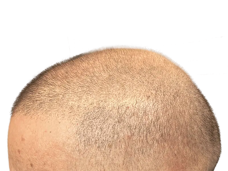 Hair restoration result: Dense, light brown hair after transplant. Improved coverage on scalp. Before/after possible.