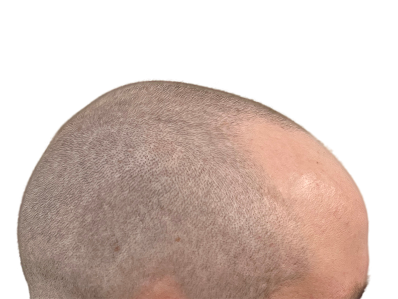 Close-up of scalp with short hair. Could be a hair restoration before/after. Evaluate hair transplant options.