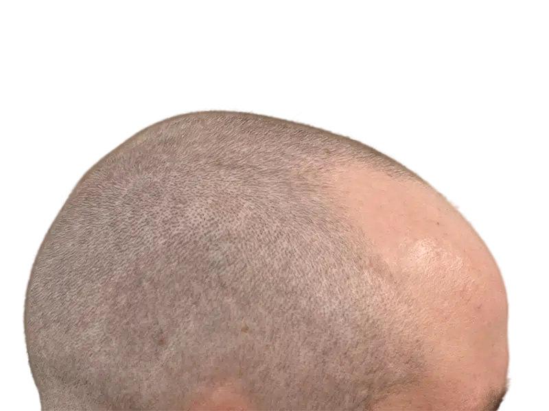 Close-up of scalp with short hair. Could be a hair restoration before/after. Evaluate hair transplant options.