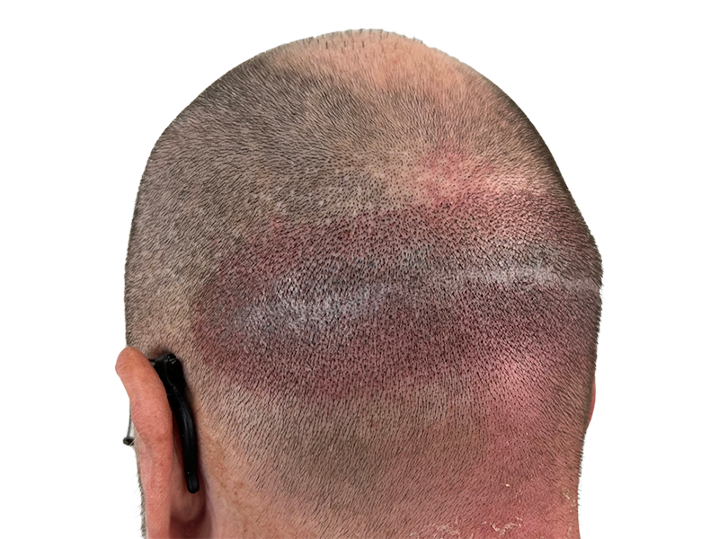 Hair transplant scar on back of head. Close-up showing post-procedure healing. Hair restoration before/after results.