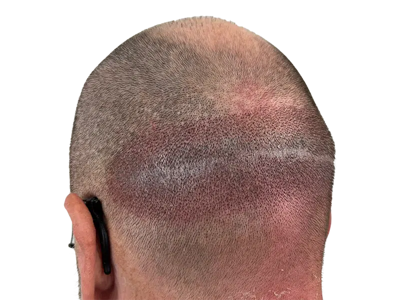 Hair transplant scar on back of head. Close-up showing post-procedure healing. Hair restoration before/after results.