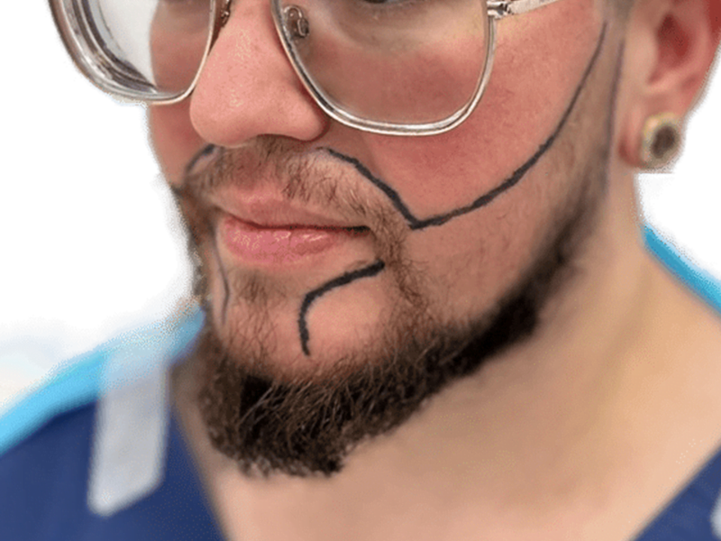 Beard transplant planning. Man with beard design lines for hair restoration. Potential before/after beard transplant.