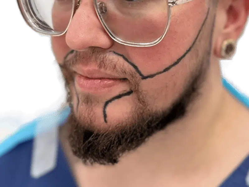 Beard transplant planning. Man with beard design lines for hair restoration. Potential before/after beard transplant.