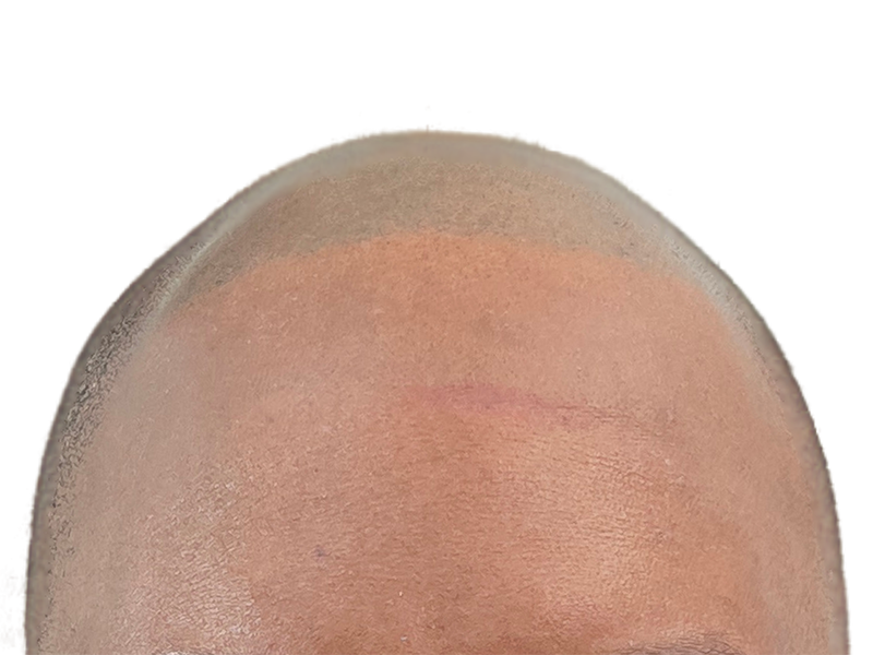 Hair transplant before & after: receding hairline restored with fuller, natural hair growth. Hair restoration results.