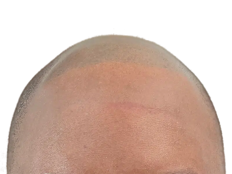Hair transplant before & after: receding hairline restored with fuller, natural hair growth. Hair restoration results.