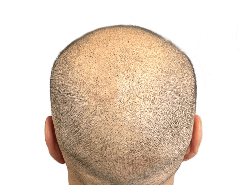Thinning hair on back of head. Potential hair restoration candidate. Consider hair transplant options for fuller coverage.