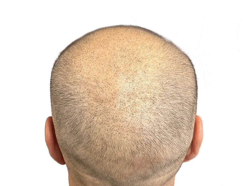 Thinning hair on back of head. Potential hair restoration candidate. Consider hair transplant options for fuller coverage.