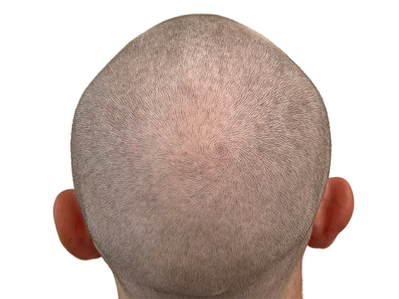 Close-cropped gray hair. Scalp visible. Potential hair restoration candidate? Consult for hair transplant options.
