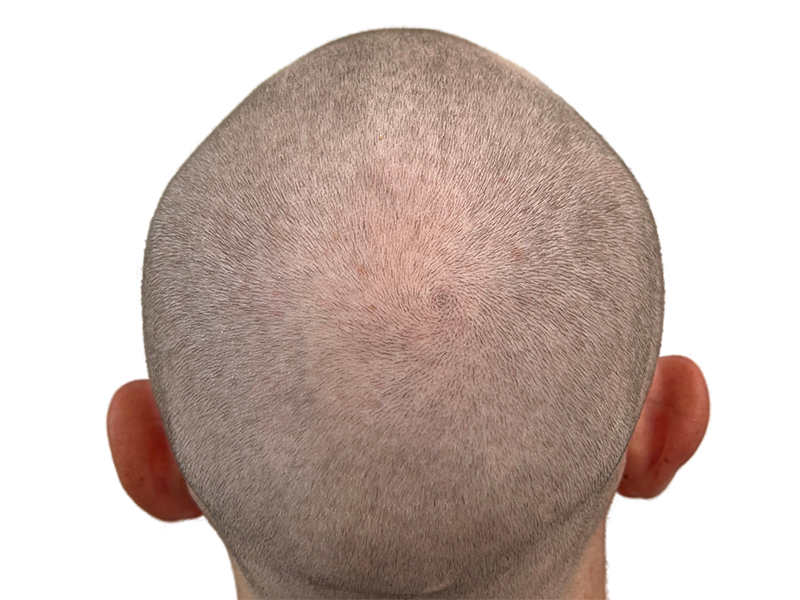 Close-cropped gray hair reveals scalp. Consider hair restoration options. Potential hair transplant candidate. Before treatment example.