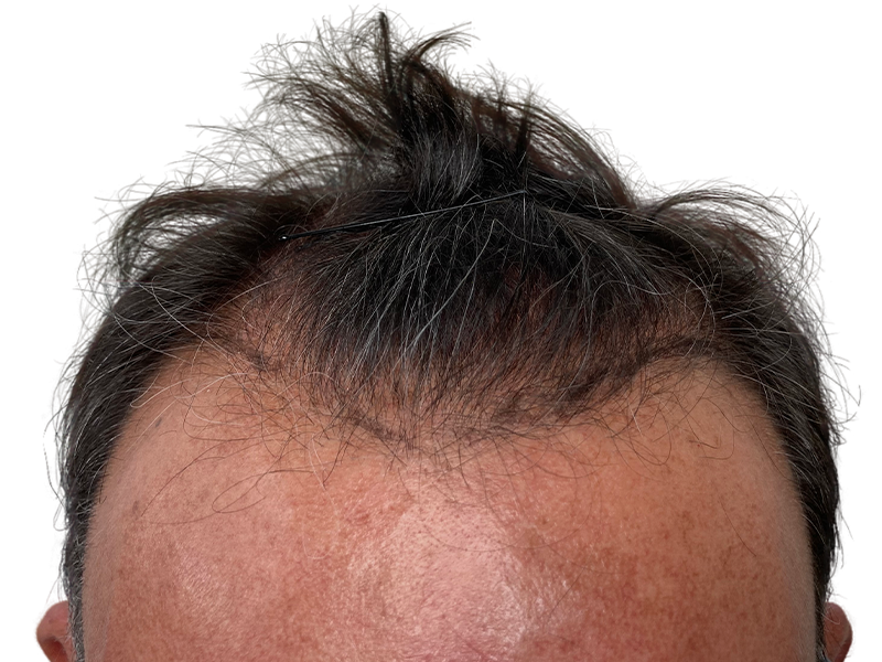 Before hair transplant: Thinning hairline on Caucasian male. Hair loss treatment candidate. Shows receding hairline.