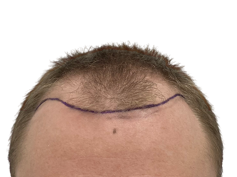 Man's receding hairline marked for hair transplant. Before hair restoration procedure. Shows thinning hair and planned hairline.