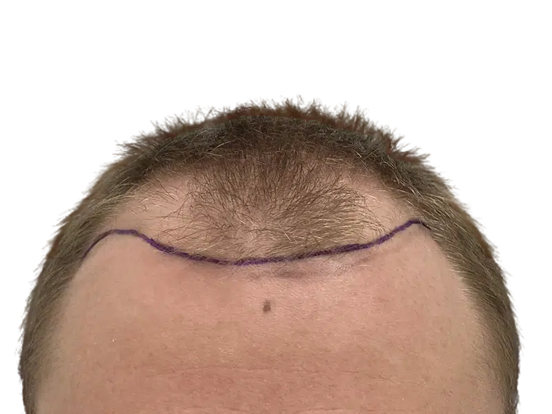 Man's receding hairline marked for hair transplant. Before hair restoration procedure. Shows thinning hair and planned hairline.