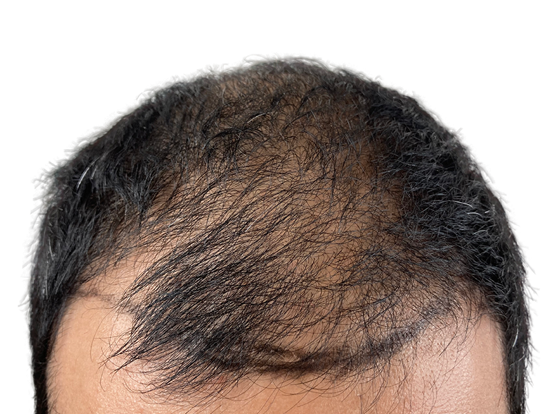 Before hair transplant: Thinning dark hair on Hispanic man's head. Hair loss visible. Hair restoration candidate.