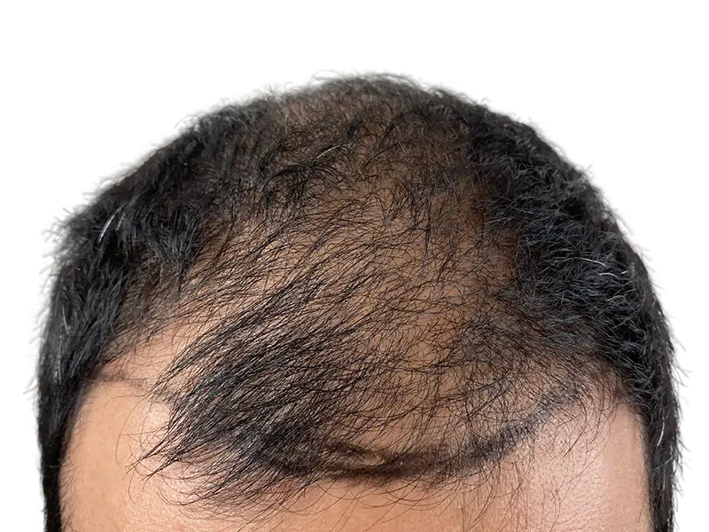 Before hair transplant: Thinning dark hair on Hispanic man's head. Hair loss visible. Hair restoration candidate.