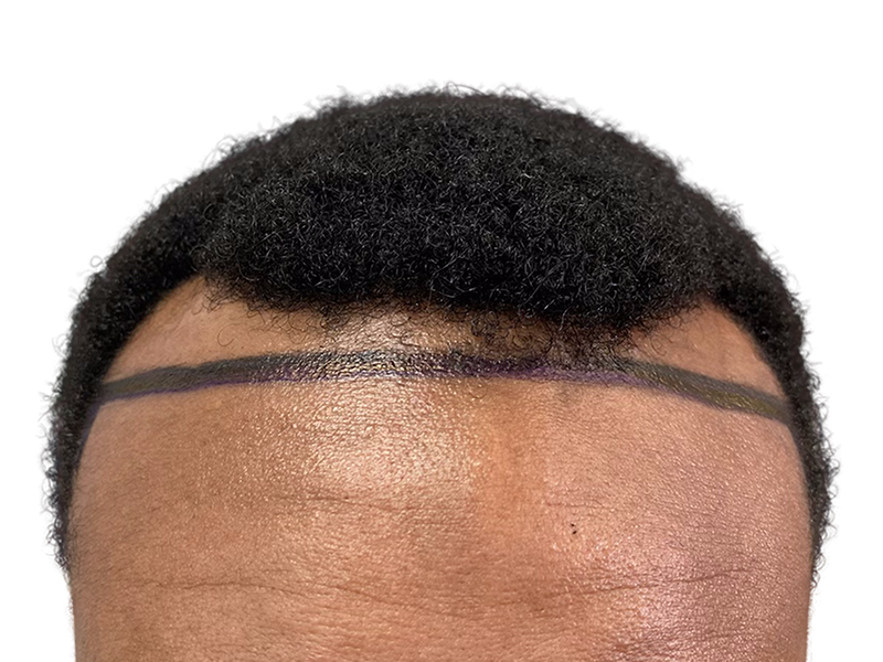 Hair transplant planning: African American male hairline marked for restoration. Shows pre-procedure guideline. No before/after.