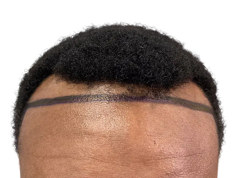 Hair transplant planning: African American male hairline marked for restoration. Shows pre-procedure guideline. No before/after.