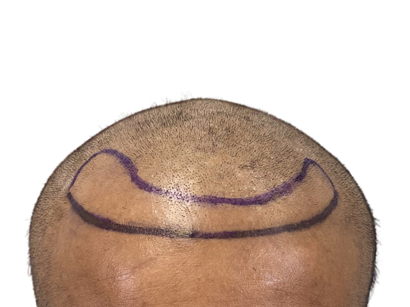 Hair transplant planning: Marked hairline on Black/Hispanic male. Thinning hair before restoration procedure.
