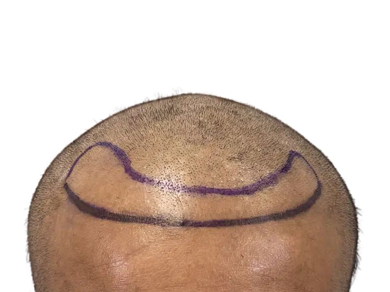 Hair transplant planning: Marked hairline on Black/Hispanic male. Thinning hair before restoration procedure.
