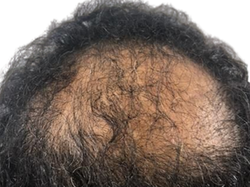 Hair loss before treatment. Thinning dark hair reveals scalp. Consider hair restoration options for balding.