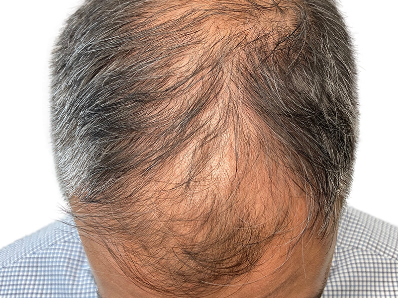 Thinning hair on a middle-aged man's head. Hair loss, receding hairline. Consider hair restoration options. Not a before/after photo.