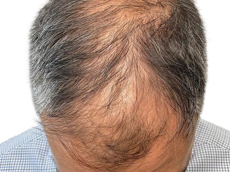 Thinning hair on a middle-aged man's head. Hair loss, receding hairline. Consider hair restoration options. Not a before/after photo.