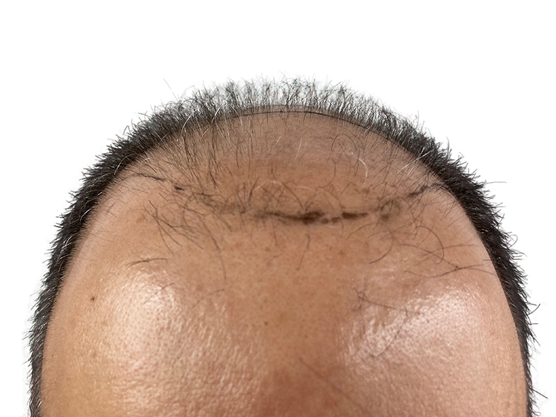 Hair transplant result: Asian man's hairline with visible scar. Before/after hair restoration procedure. Sparse to fuller hair.