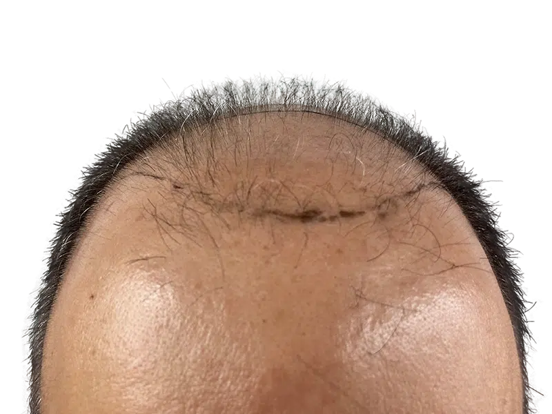 Hair transplant result: Asian man's hairline with visible scar. Before/after hair restoration procedure. Sparse to fuller hair.