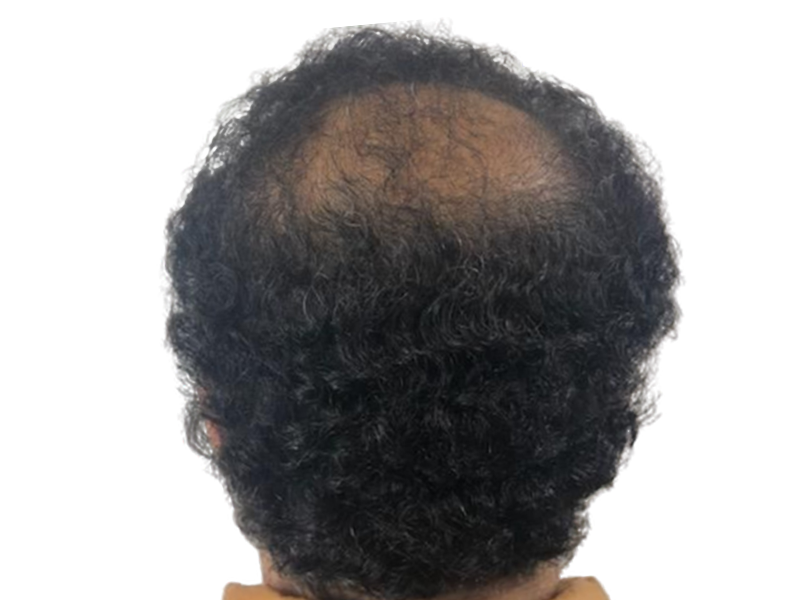Thinning hair on crown. Potential hair restoration candidate. Before hair transplant. Dark, curly hair. Scalp visible.