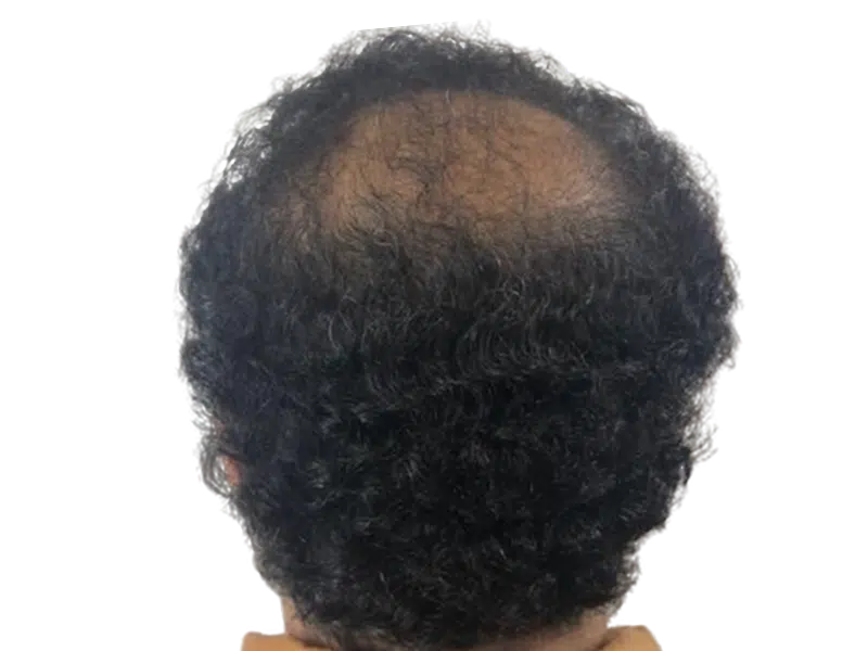 Thinning hair on crown. Potential hair restoration candidate. Before hair transplant. Dark, curly hair. Scalp visible.