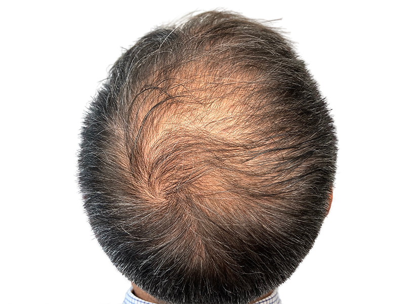 Thinning hair & visible scalp. Hair restoration can help. Before hair transplant example. Caucasian male.