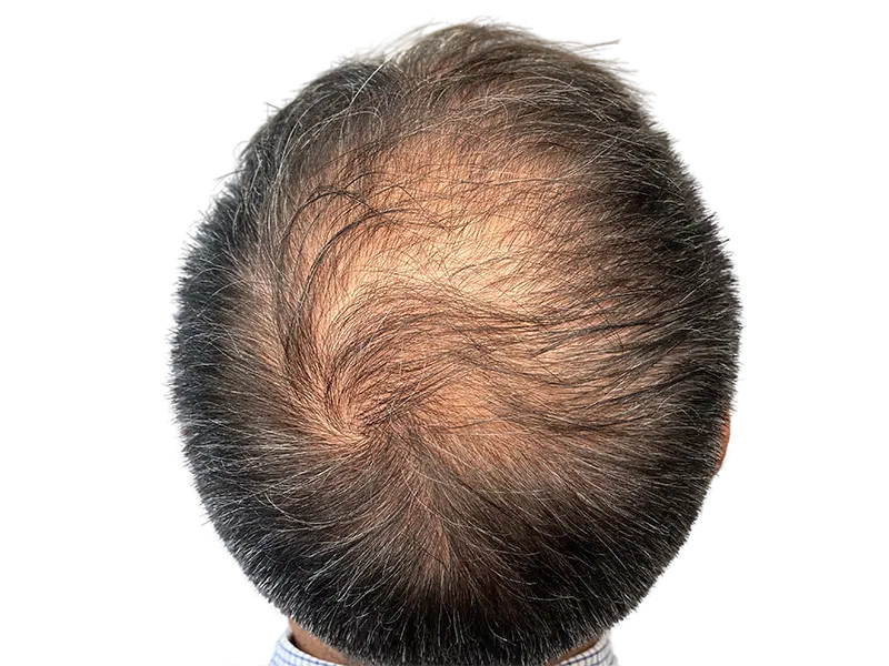 Thinning hair & visible scalp. Hair restoration can help. Before hair transplant example. Caucasian male.