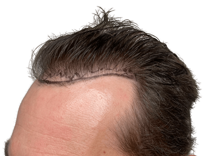 Hair transplant result: New hairline on Caucasian man. Before & after showcasing hair restoration procedure.