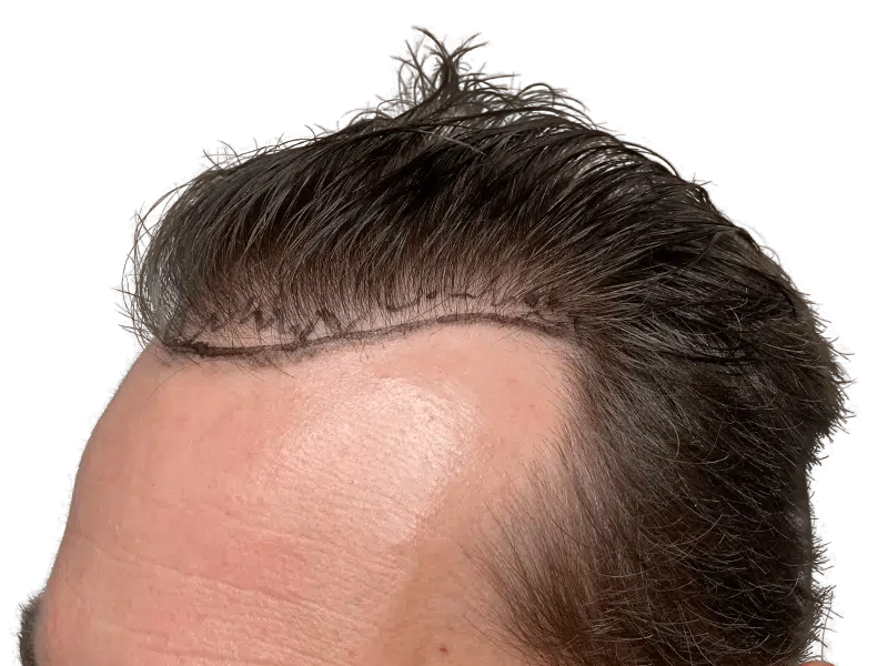 Hair transplant result: New hairline on Caucasian man. Before & after showcasing hair restoration procedure.