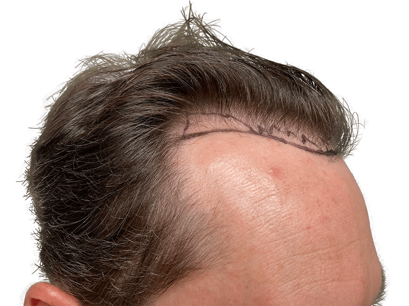 Before hair transplant: Thinning hairline marked for restoration. Caucasian male, dark hair. Hair restoration results.