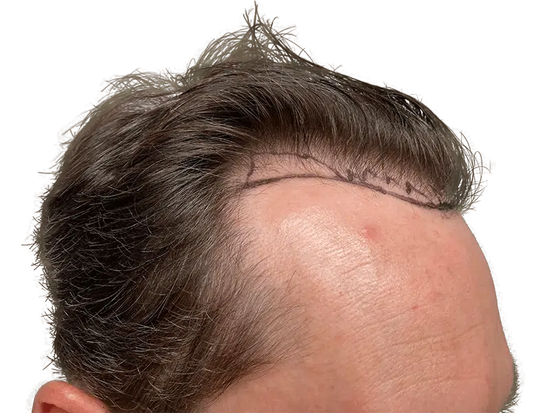 Before hair transplant: Thinning hairline marked for restoration. Caucasian male, dark hair. Hair restoration results.