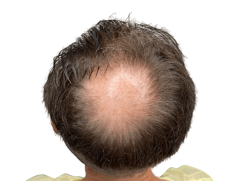 Thinning hair & receding hairline. Hair loss before hair restoration treatment. Could be a candidate for hair transplant.